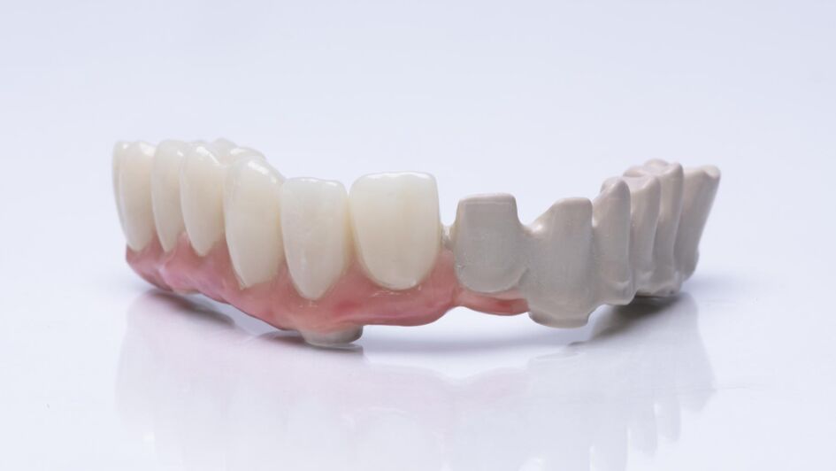 基于VESTAKEEP® PEEK的牙体修复智能技术SIEWERTBRIDGE®。右：由自然色PEEK材料制成的桥体结构。左：高透光全锆贴面的牙体成品（©Evonik）。